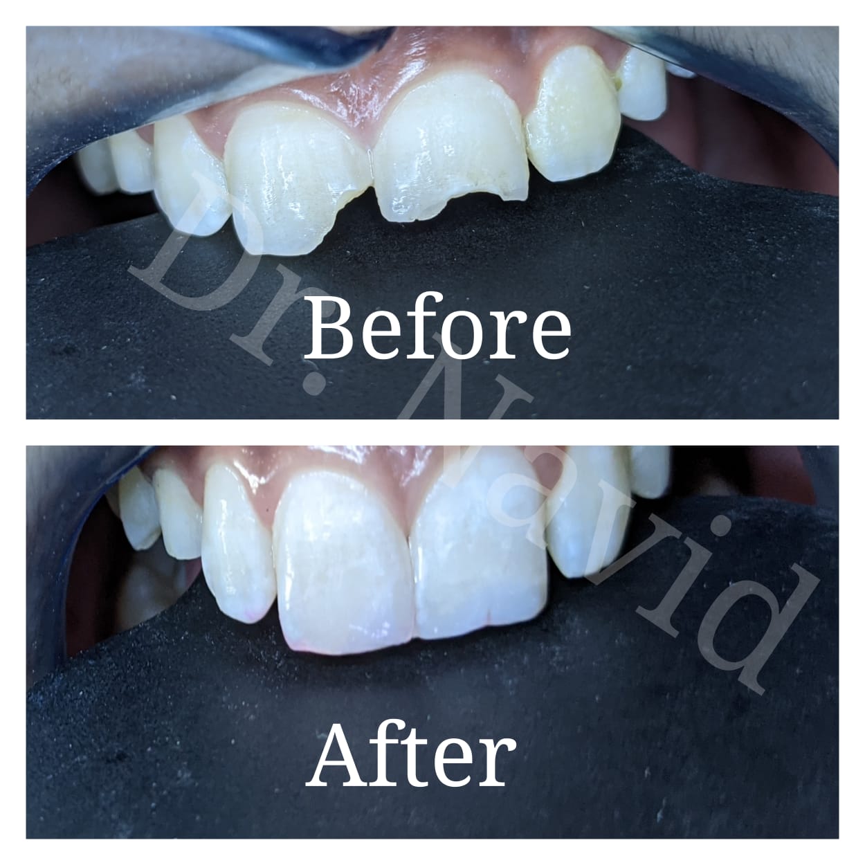 Chipped Tooth Restoration