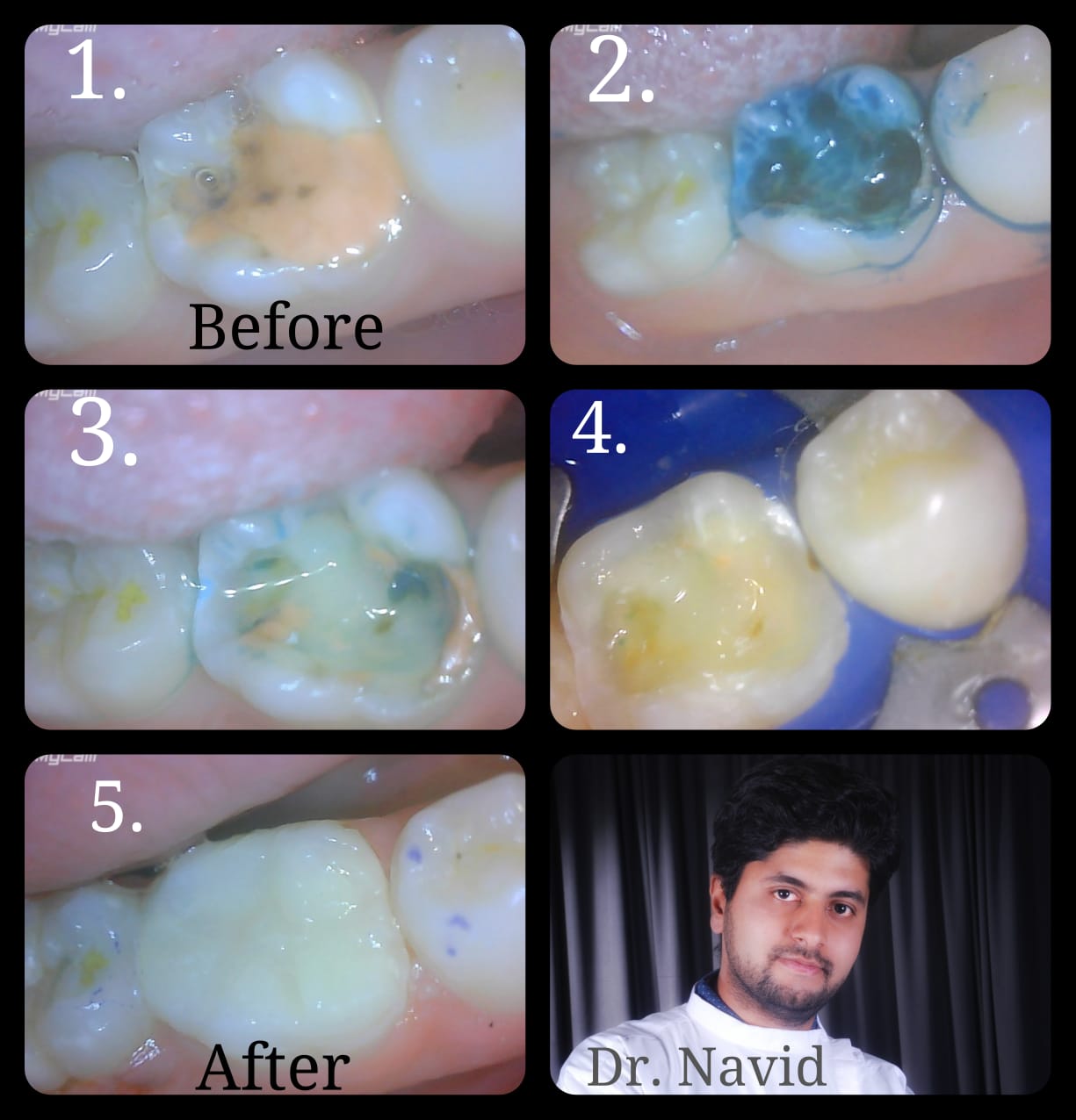 Cavity & Decay Treatment