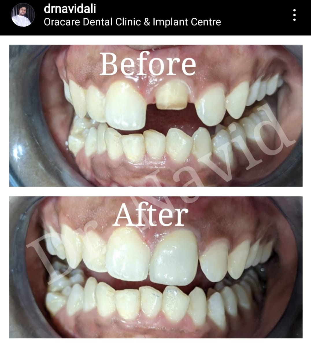 Crown & Cap Placement