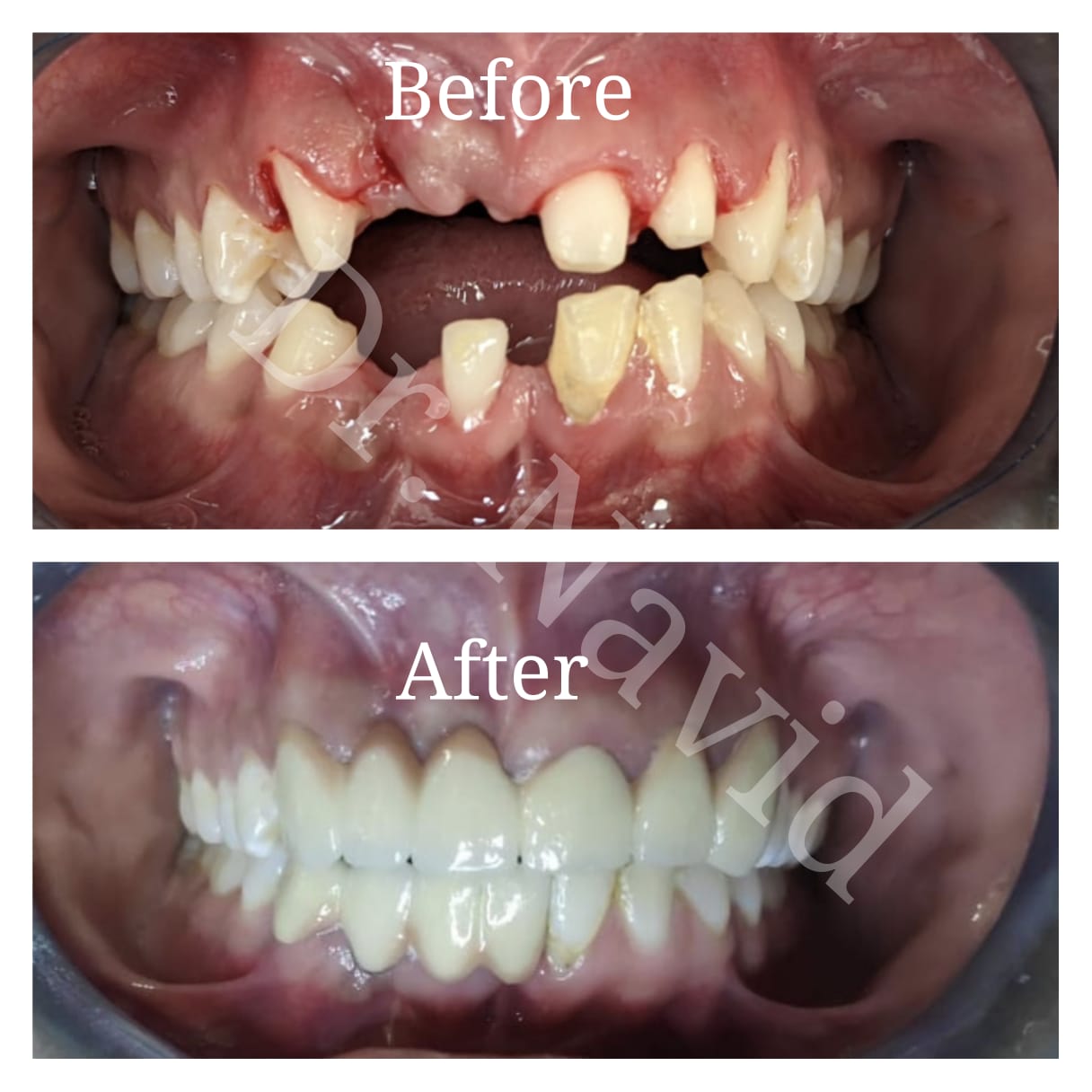 Full Mouth Rehabilitation