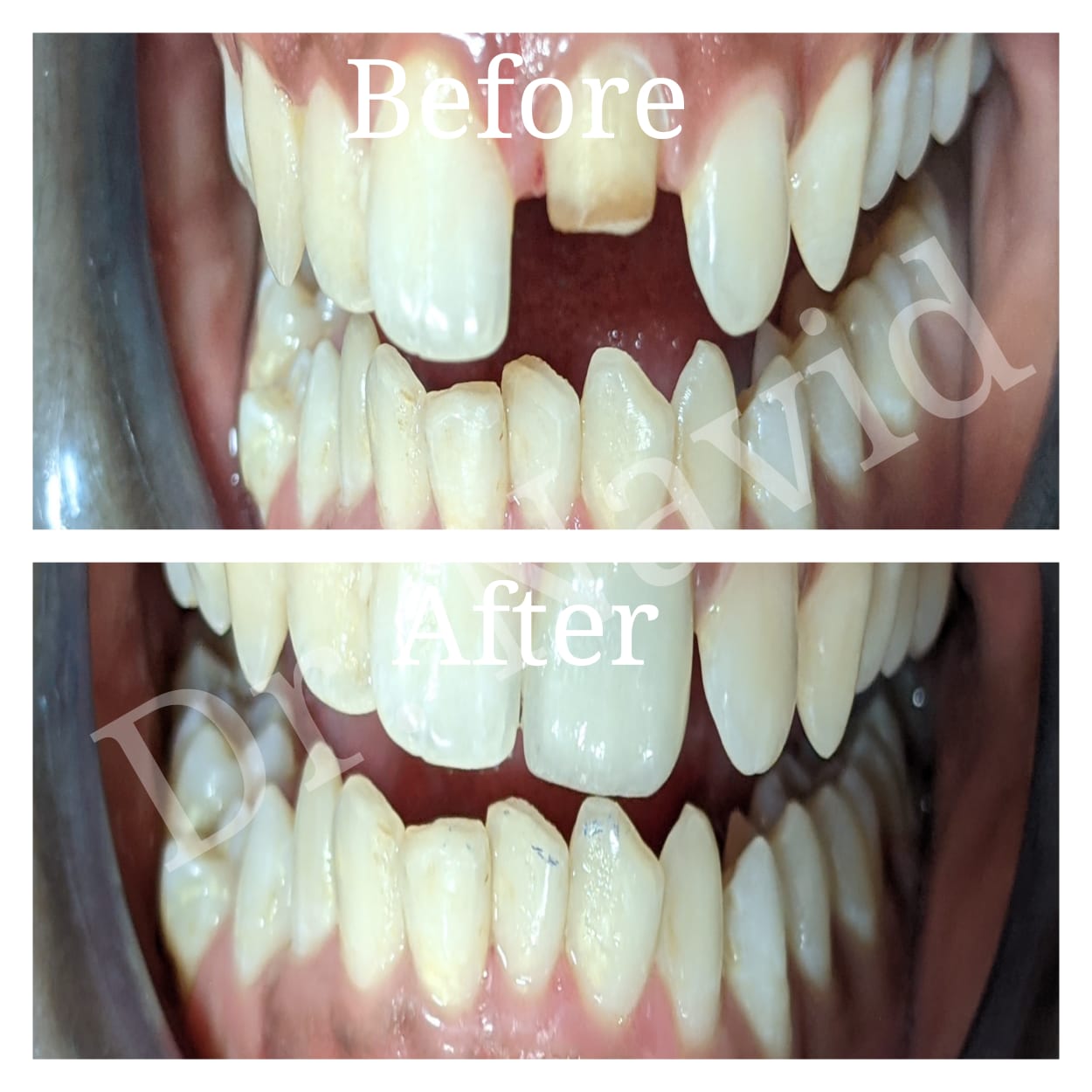 Implant Crown Restoration