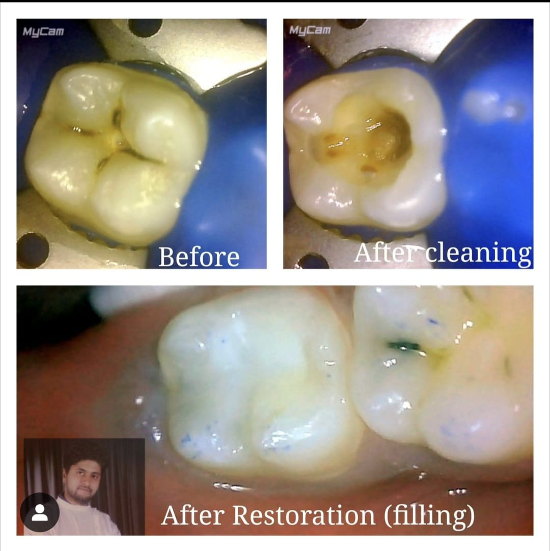 Tooth Coloured Filling